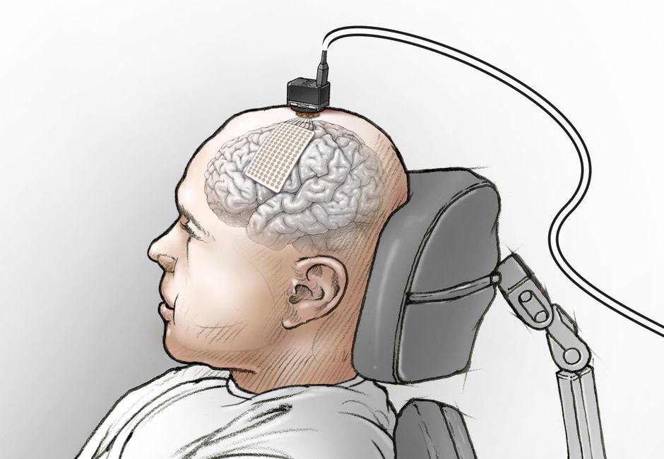 Speech neuroprosthesis converts brain signs into words on a screen